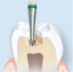 Удаление размягчённых<br>тканей из полости зуба