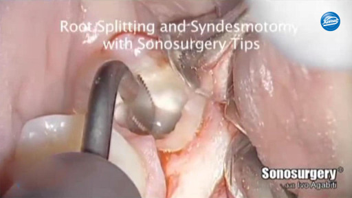 Shaping the occlusal surface