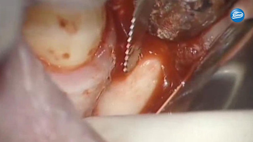 Shaping the occlusal surface